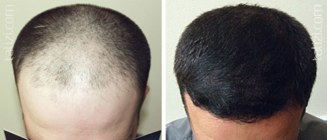 Zašto je teško i brzo opadanje kose kod muškaraca?