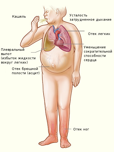 Os sintomas de insuficiência cardíaca