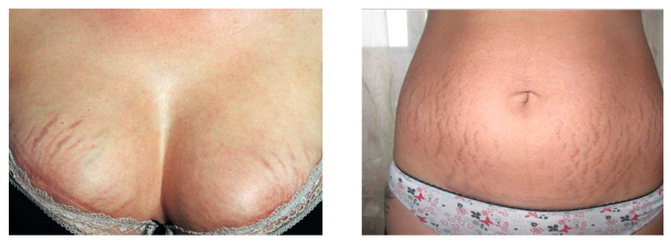 The causes of the appearance of stretch marks on the skin