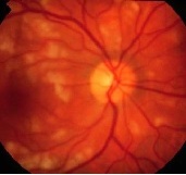 Retinalna angiopatija