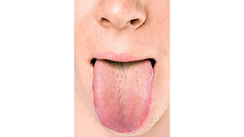 rivestimento giallo-verde sulla lingua