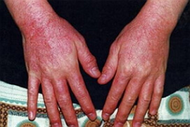 Dermatite alérgica foto