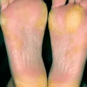 Hyperkeratosis of the feet: treatment with ointments and folk remedies