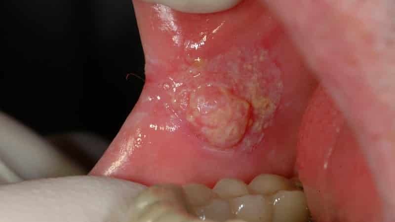 The cone in the mouth on the cheek( the ball inside the cheek) - what to do if formed