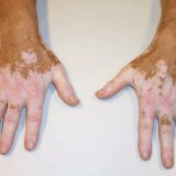 Méthodes populaires de traitement du vitiligo
