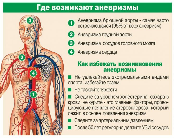 Cerebralne aneurizme: simptomi, liječenje, operacije aneurizme