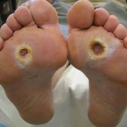 Diabetic foot: causes, symptoms and treatments