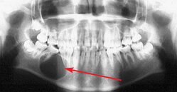 Cyst of the jaw Photo