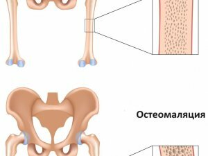 Symptoms of osteomalacia
