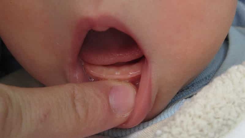 Dentition enfant à 3 mois
