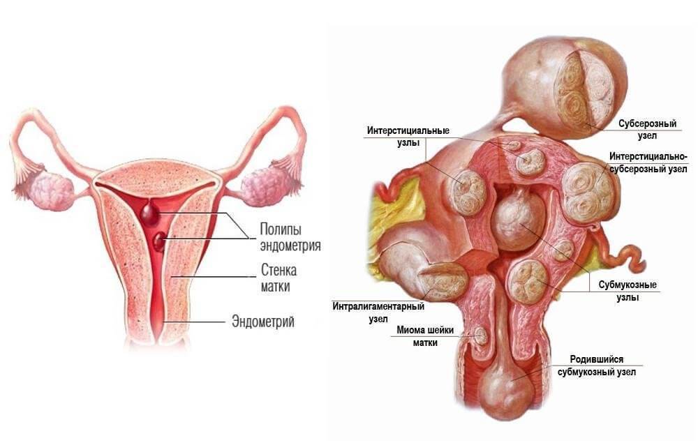 Polyps in the uterus, what is it, symptoms and treatment, causes, photo