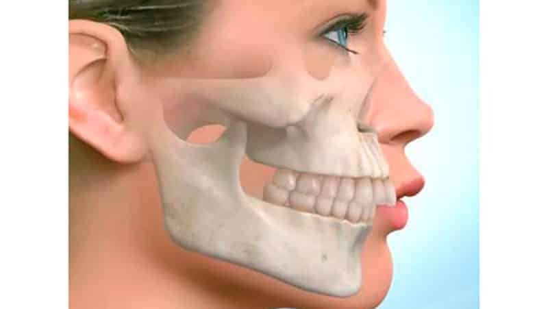 Distal Okklusion: Fotos vor und nach den Zahnspange