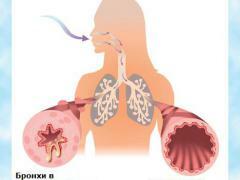 Folks behandling av obstruktiv bronkitt - erfaring i medisin