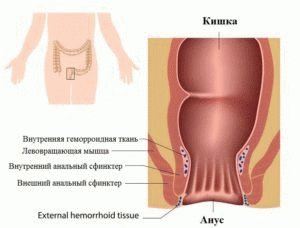 Acute aambeien