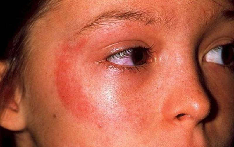 Alergie na slunce - fotodermatit