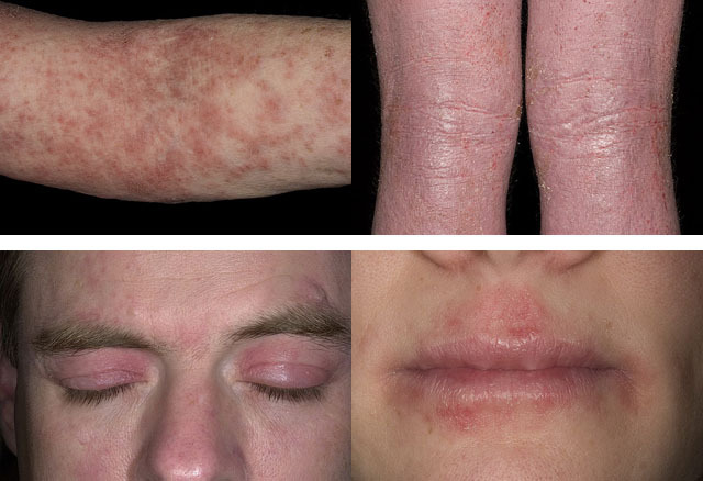 atópiás dermatitis