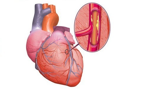 Диффузный мелкоочаговый. Атеросклеротический кардиосклероз н2а что это. Формы кардиосклероза очаговый. Диффузный мелкоочаговый кардиосклероз. ИБС мелкоочаговый кардиосклероз.