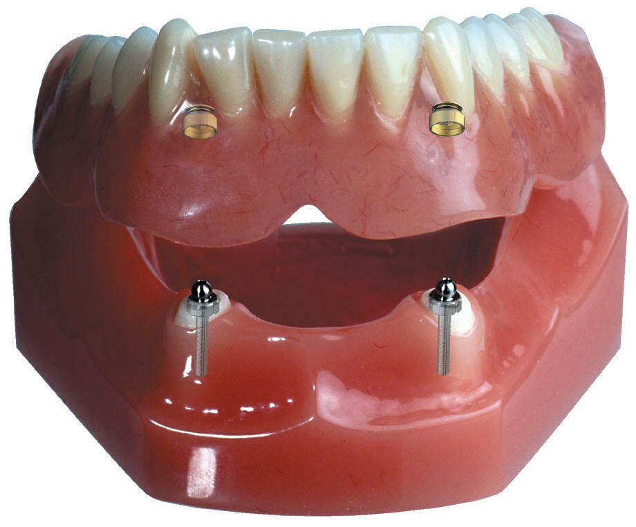 lamináris fogsor rögzítve az implantátumok