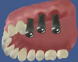 Az ortopéd fogászati ​​implantátumok és