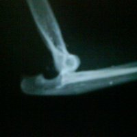 Dislocation of the elbow joint