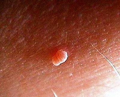 Papilloma-on-the-skin