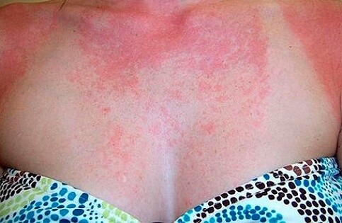 Photo of sun allergies
