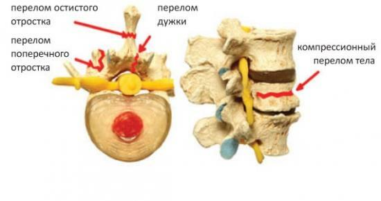 Típusú törések a gerinc