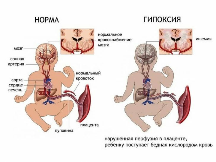 Intrauterine fetal hypoxia