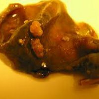 Polyp of the gallbladder