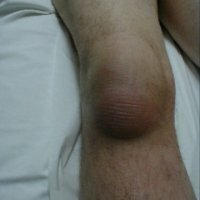 Bunion kolenného kĺbu