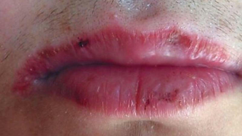 was und wie Cheilitis auf den Lippen zu Hause behandeln