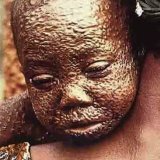 Smallpox: symptoms, treatment, prevention