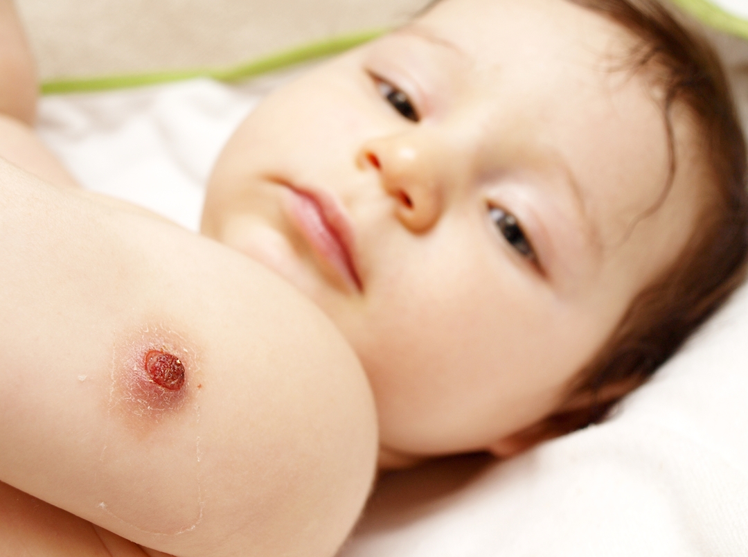 Armas beebi tüdruk pealepanemise tagasi, BCG vaktsineerimise haava õlale