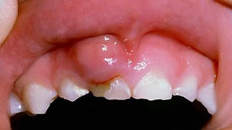 Den skölja munnen med inflammation i tandköttet och blödande tandkött