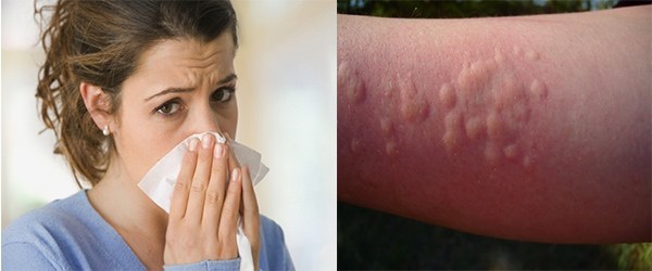 manifestacija alergije na koprivu