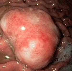 Antrale atrofische gastritis: oorzaken, symptomen en behandeling