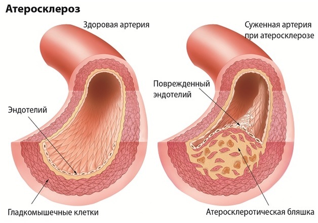 Simptomi, vzroki in posledice ateroskleroze cerebralne arterije