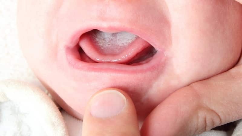 Bumps sulla lingua del bambino: foto e il trattamento
