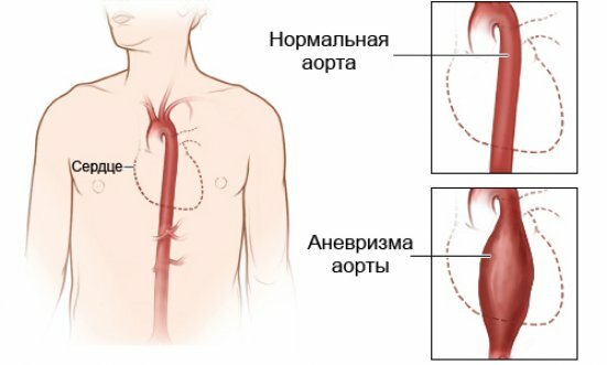 Reakcióvázlat-köteg-aorta