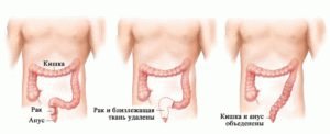 Verwijdering van poliepen in het rectum: voorbereiding, laserchirurgie, poliepectomie en gevolgen