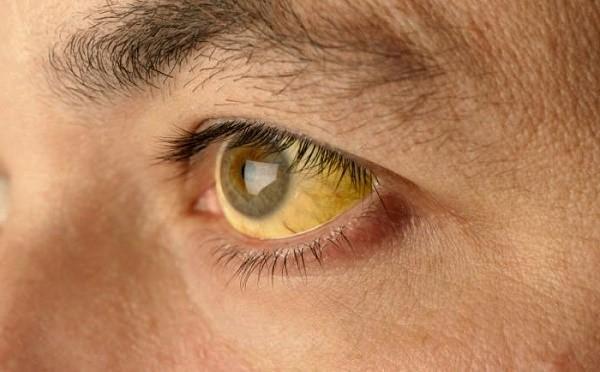 Ak súbežne s pankreasom postihne aj žlčník, môže sa vyvinúť žltačka: koža a očné bielka zožltnú, moč stmavne.