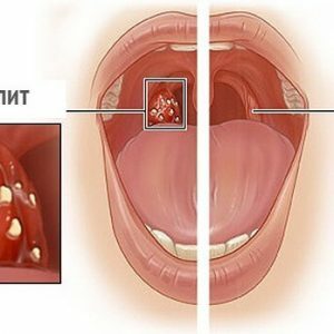 De bacteriële tonsillitis: symptomen en de behandeling thuis - Okey docs